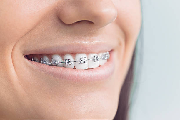 Best Veneers and Lumineers  in Scissors, TX